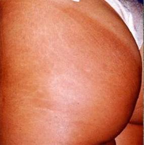 stretch mark removal_After