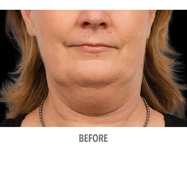 double_chin_fat_removal_before